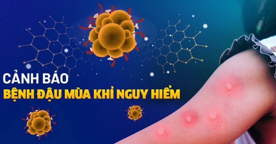 Bệnh đậu mùa khỉ tuy khó lây hơn COVID-19 và các triệu chứng cũng không quá nghiêm trọng, nhưng đây vẫn là một căn bệnh nguy hiểm.